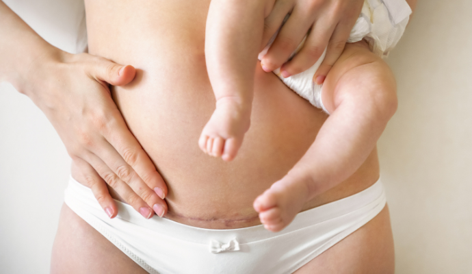 C-Section Recovery Tips